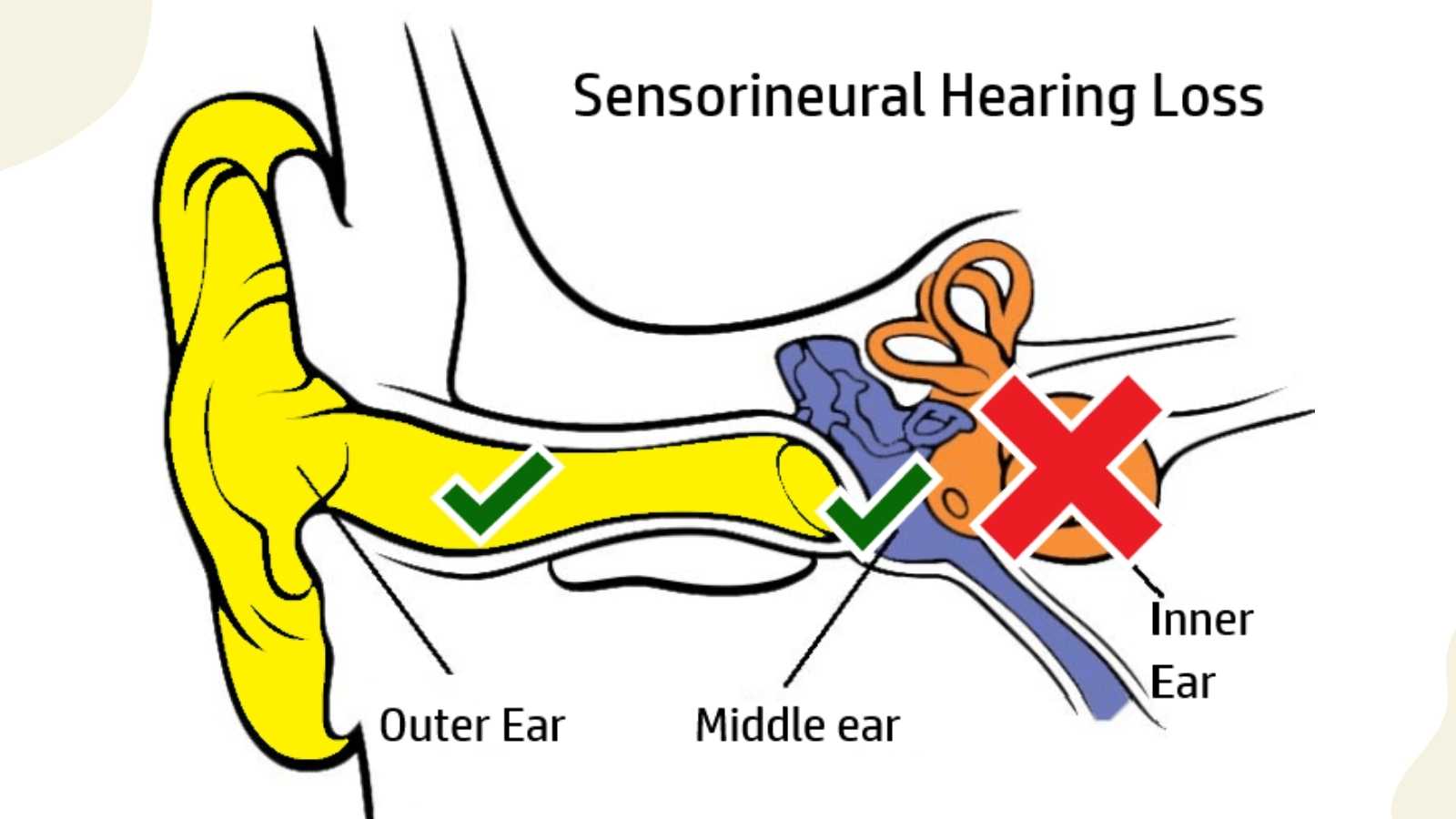 Bone Anchored Hearing Aids (BAHA) Vs Cochlear Implants and Traditional ...