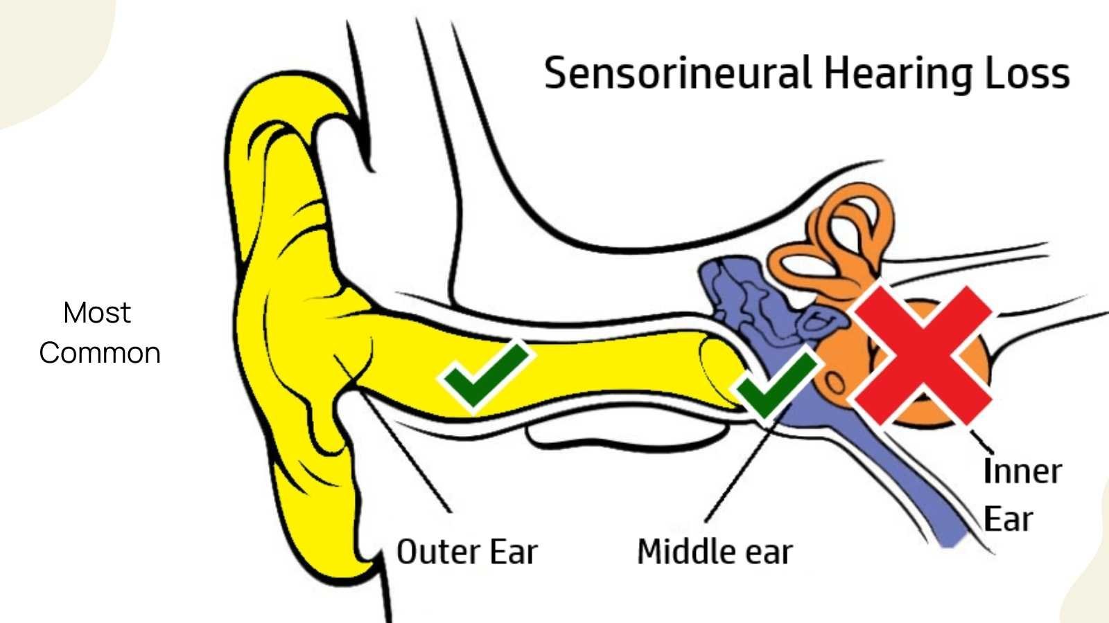 Image showing Sensorineural hearing loss